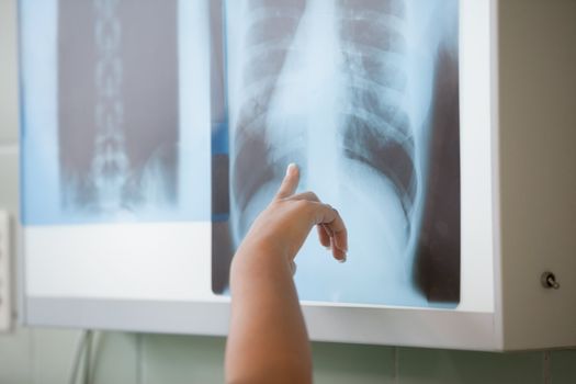 Close up of people showing a X-ray in operating theater