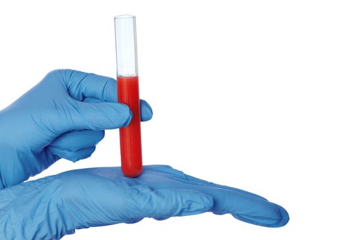 Doctor in blue gloves will be carry out research a samples of bloods at inhabitants of coast on availability of poisoning