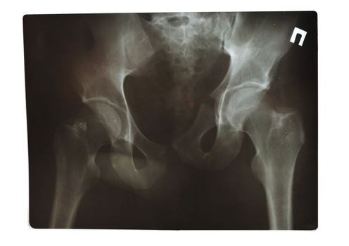 X-Ray pelvis shot isolated on white