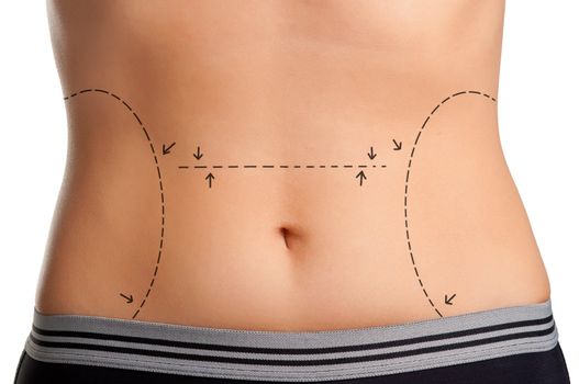 Tummy marked for plastic surgery