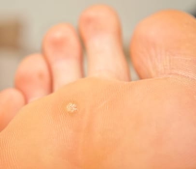 Callus and hyperkeratosis on feet, closeup, dried skin