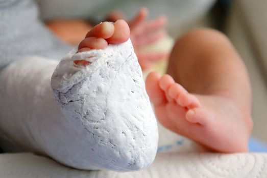 Close up of baby foot in bandage and cast