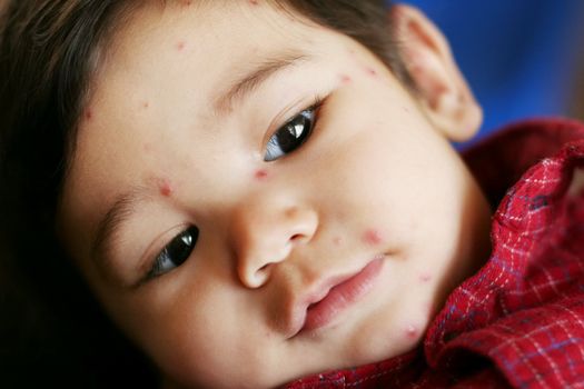 Baby boy with chicken pox closeup