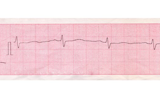 Medical inspection and health. Heart analysis scheme. Cardiogram 