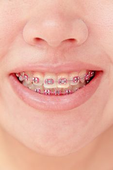 girl smiling with braces on teeth,dental concept