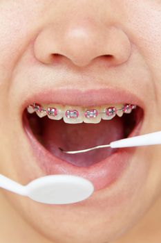 girl smiling with braces on teeth,dental concept