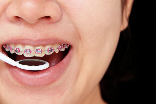 girl smiling with braces on teeth,dental concept