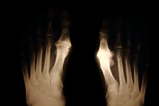 x-ray of foots as nice medical background