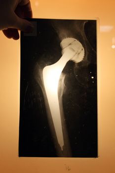 x-ray of hip endoprosthese as nice medical background
