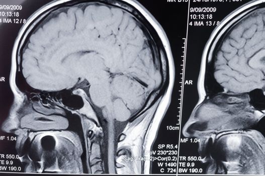 Closeup of a computer axial tomography scan (CAT scan) of a head