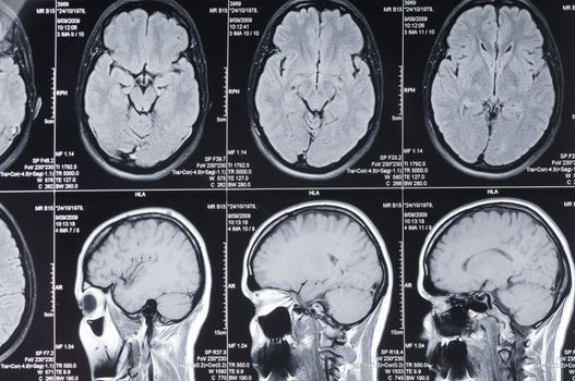 Closeup of a computer axial tomography scan (CAT scan) of a head