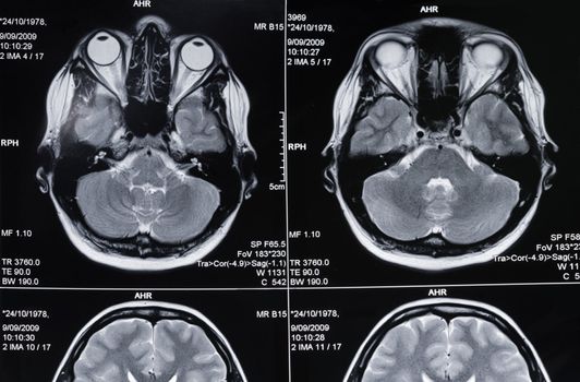 Closeup of a computer axial tomography scan (CAT scan) of a head