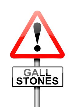 Illustration depicting a sign with a Gall stones concept.