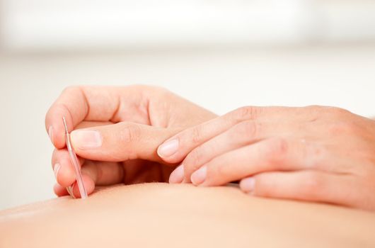 Two hands using an insertion tube with a Goshin acupuncture needle to insert a needle in the back of a patient