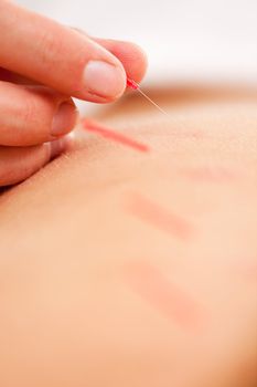 Macro detail of an acupuncturist rotating and stimulating a needle