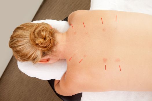 Acupuncture needles along Back Shu points on patients back