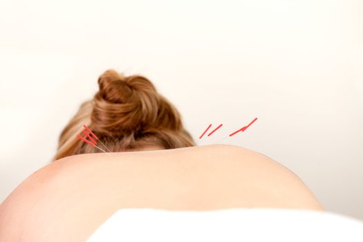 Female patient with acupuncture needles along the Shu Points on the back.