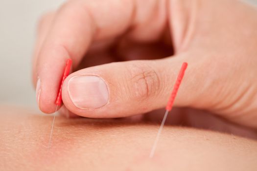 Macro detail of a hand stimulating an acupuncture needle on the back of a patient