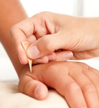 Hand of a young male receiving acupuncture treatment with a Yoneyama tool