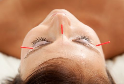 Anti-aging acupuncture treatment on young attractive female patient