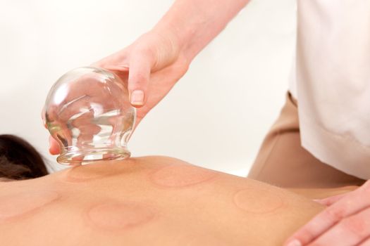 Detail of the hand of an acupuncture therapist removing a fire cupping bulb