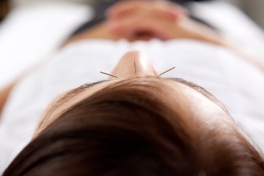 Macro detail of three needles in face of acupuncture patient