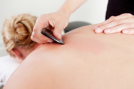 Woman receiving gua sha acupuncture treatment on back