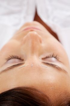 Facial acupuncture treatment on young attractive woman