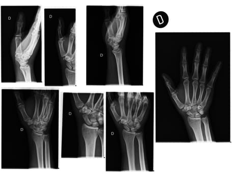 Real X-rays of the Hand and wrist. (broken wrist)