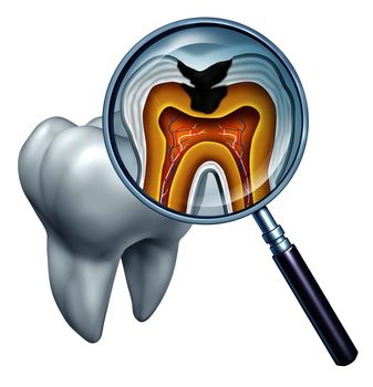 Tooth cavity close up and cavities symbol showing a magnifying glass with a cross section of a tooth anatomy in decay due to bacteria and acids in oral health care showing rotting and disease due to lack of brushing.