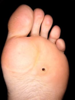 Callus under foot, isolated towards black background