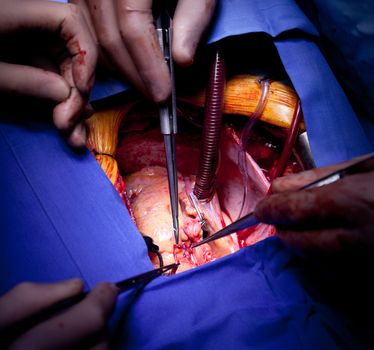 Detailed close-up of doctors hands performing cardiac surgery