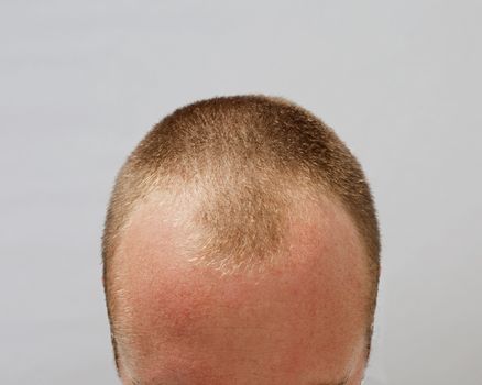 A balding man in his late twenties shows his hairloss.