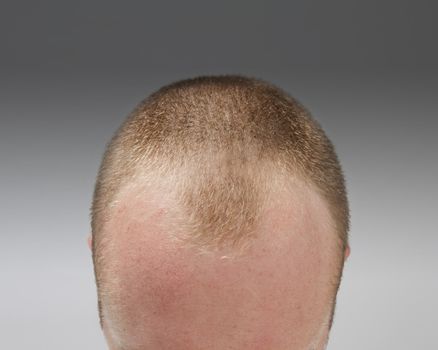 A caucasian man in his late twenties shows his hairloss.