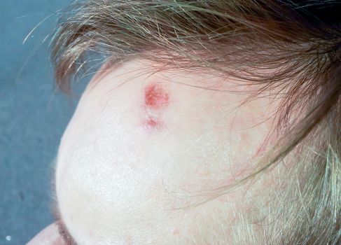 Male person with wound on forehead under the hair bang