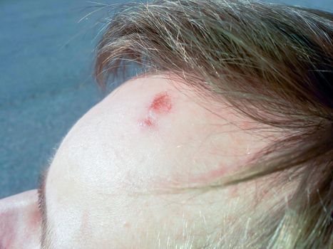 Male person with wound on forehead under the hair bang