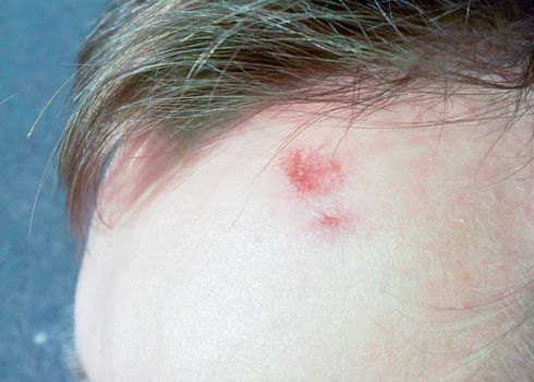 Male person with wound on forehead under the hair bang