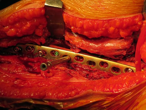 A titanium plate fitted in the thigh of a patient during surgery, to support a broken bone.                               