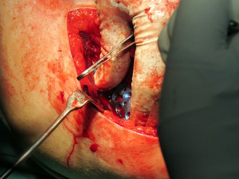 A doctor fixing a titanium plate in the shoulder of a patient during a surgery.                               