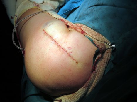 A well stitched shoulder of an accident patient after a surgery