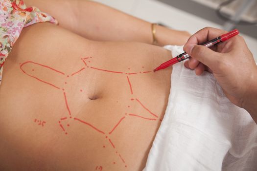 Plotting Points for Acupuncture Treatment