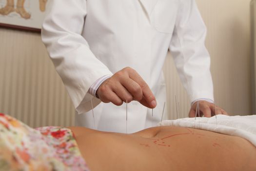 Inserting Acupuncture Needles
