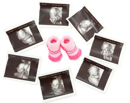 Group of 3D/4D Ultrasound images around a pair of pink baby booties.