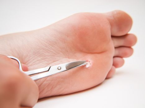 Person with callus located under foot, treated with a pair of scissors