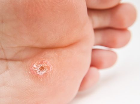 Person with callus located under foot, close to toes towards white