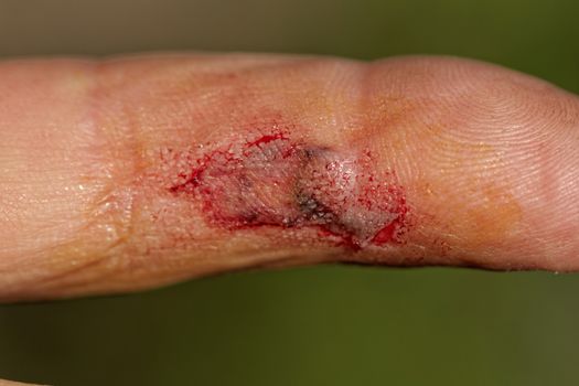 Flesh wound with blood on male finger
