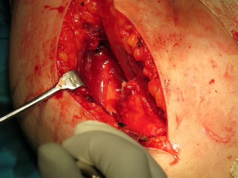 A shoulder with a broken bone opened for a surgery by surgeons