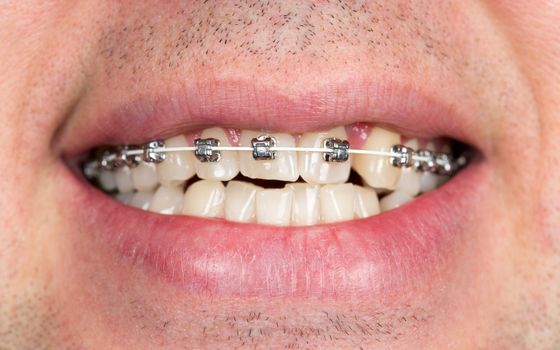 Close-up of braces on the teeth of the upper jaw with unshaven men