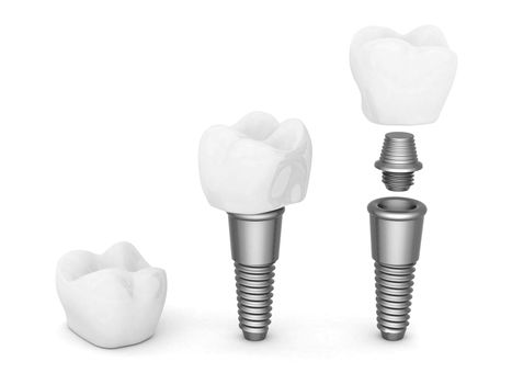 Dental implants isolated on white background