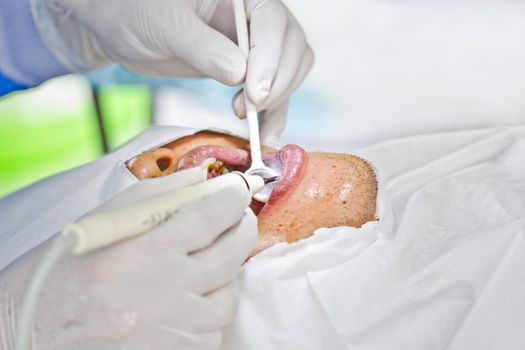 special dental prophylaxis service in rural areas